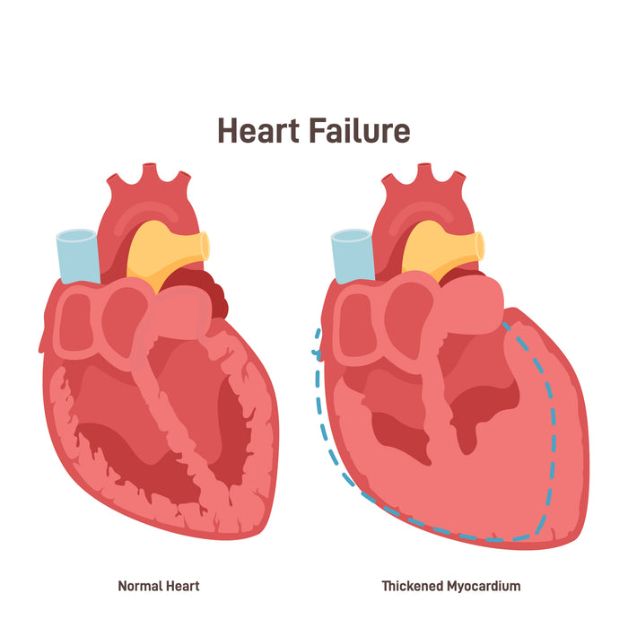 Heart failure illustration