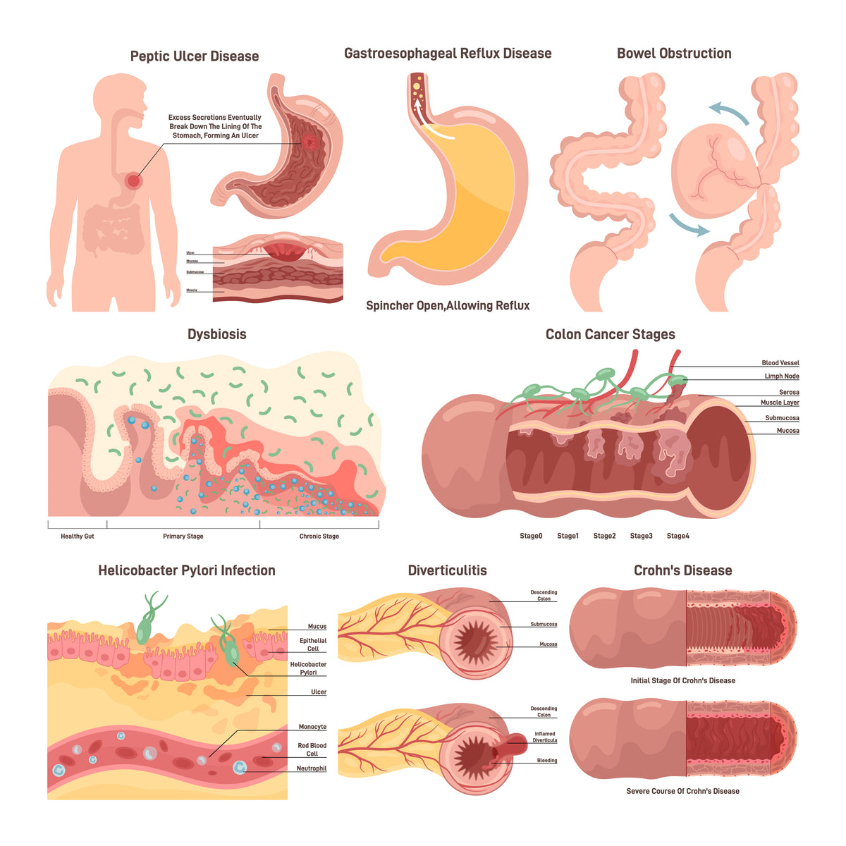 Digestive system diseases set