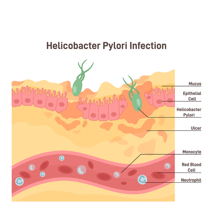 Helicobacter pylori infection