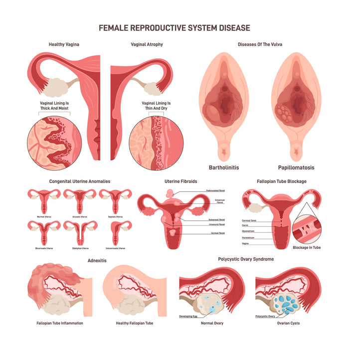 Female reproductive system disorder