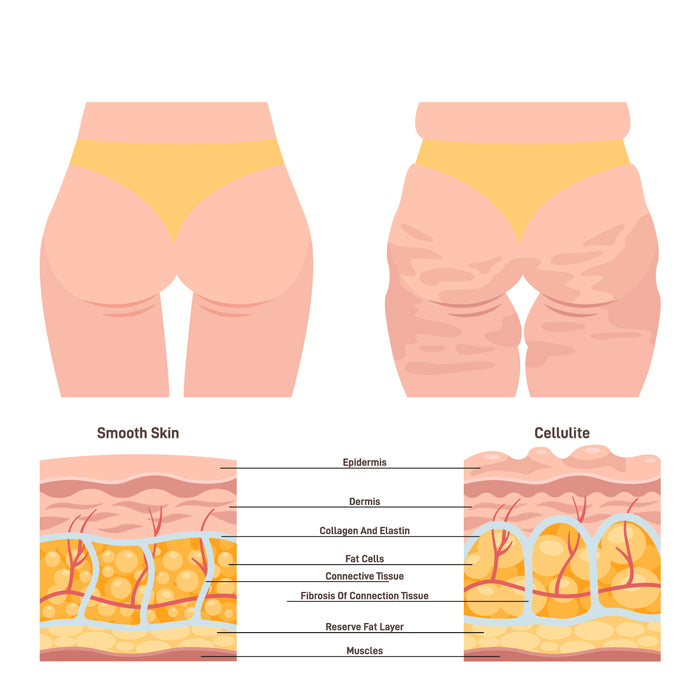 Cellulite and healthy skin structure