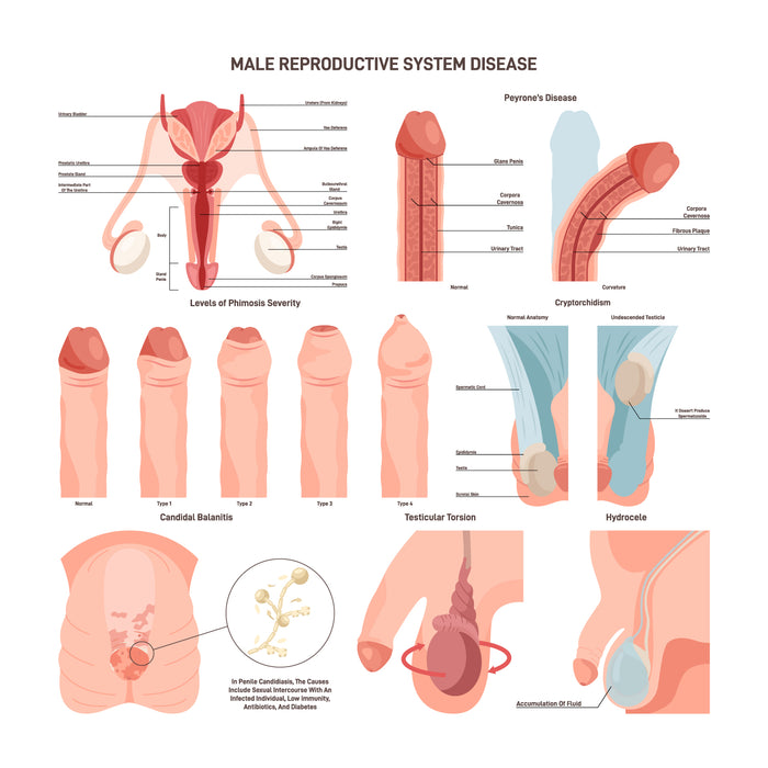 Male reproductive system disorder