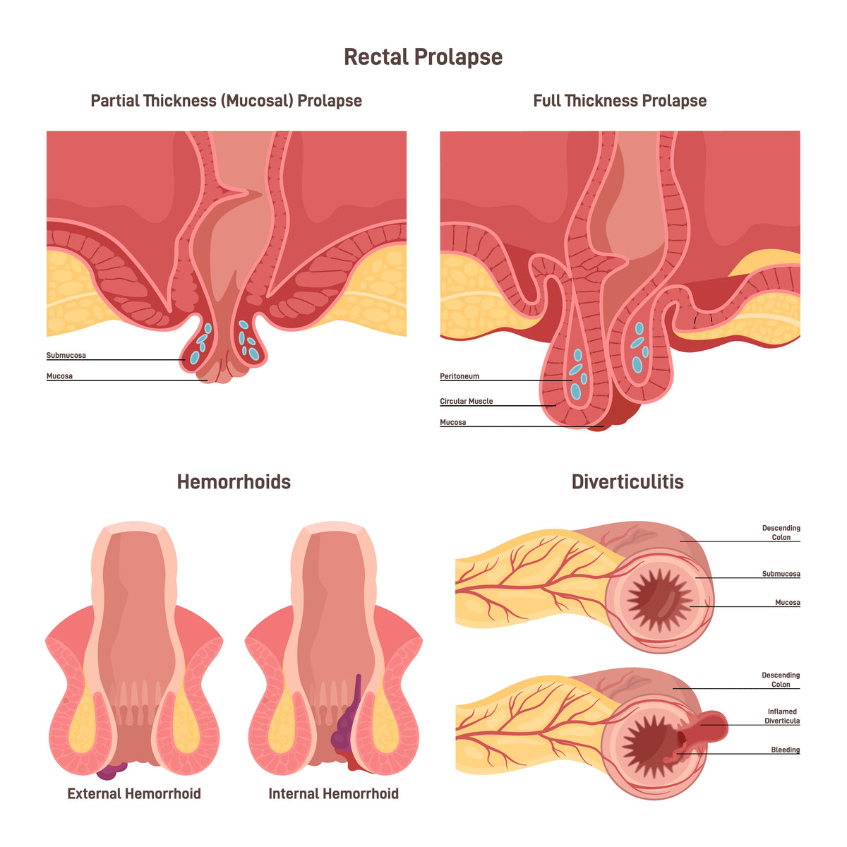 Proctological diseases set